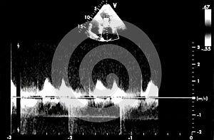 Cardiac ultrasound images . Doppler echo