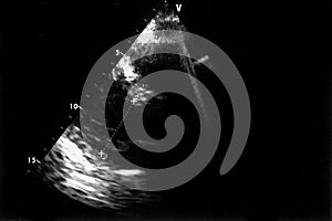 Cardiac ultrasound images . Doppler echo