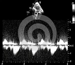 Cardiac ultrasound images . Doppler echo