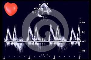 Cardiac ultrasound images and small heart . Doppler echo