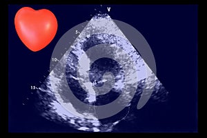 Cardiac ultrasound images and small heart . Doppler echo