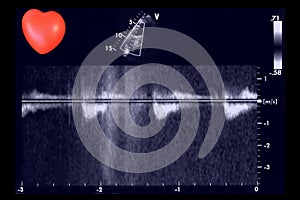 Cardiac ultrasound images and small heart . Doppler echo