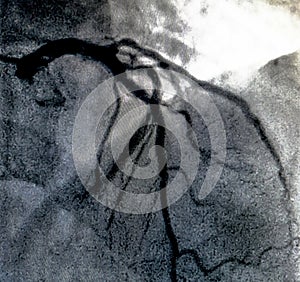 Cardiac ventriculography. Catheterization