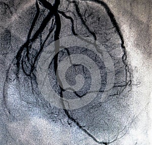 Cardiac ventriculography. Catheterization