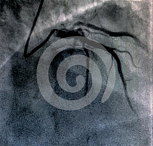 Cardiac ventriculography. Catheterization