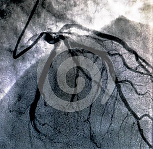 Cardiac ventriculography. Catheterization