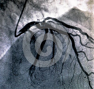 Cardiac ventriculography. Catheterization