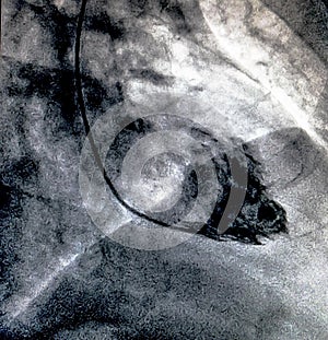 Cardiac ventriculography. Catheterization