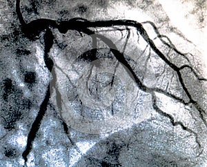 Cardiac ventriculography. Catheterization