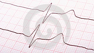 cardiogram of heart impulses, hypertonic disease concept