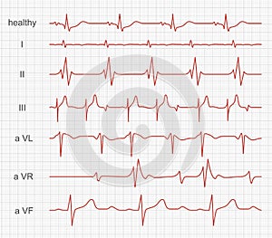 Cardiogram, heart red rhythm on monitor screen