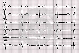 Cardiogram. Heartbeat. The graph on graph paper.