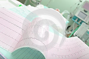 Cardiogram of a patient with acute cardiovascular failure