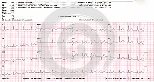 Cardiogram. waveform from an EKG showing borderline EKG test.