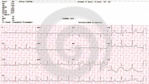 Cardiogram. waveform from an EKG showing normal EKG test.