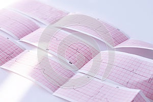 Cardiogram of young person. ECG diagram, medical examination. Heart disease,mitral valve prolapse click-murmur syndrome