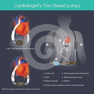 A Cardiologist`s Tool heart pump photo