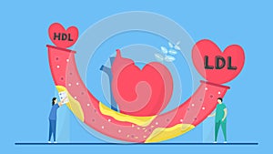 Cardiology vector illustration. This disease is narrowing of coronary arteries that caused by atherosclerosis. More cholesterol