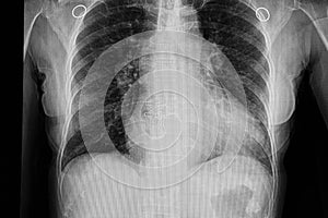 cardiomegaly with congestive heart failure