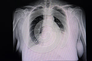 cardiomegaly and left pleural effusion
