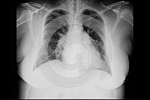 cardiomegaly