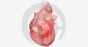 Cardiomyopathy is a disease of the heart muscle that causes the