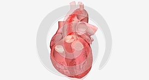 Cardiomyopathy is a disease of the heart muscle that causes the