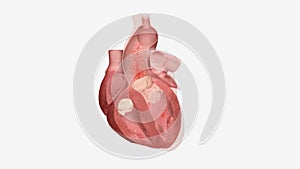 Cardiomyopathy is a disease of the heart muscle that causes the heart to have difficulty pumping blood to the body.