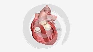 Cardiomyopathy is a disease of the heart muscle that causes the heart to have difficulty pumping blood to the body.