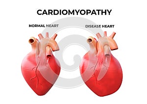 Cardiomyopathy is inflammation in the heart muscle, resulting in its enlargement and weakening that impairs the blood`s pumping