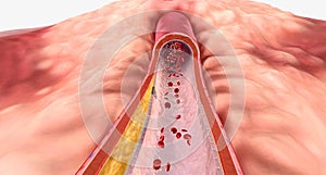 Cardiovascular disease is commonly caused by atherosclerosis and restricted blood flow through an artery