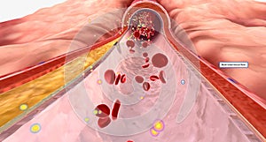 Cardiovascular disease is commonly caused by atherosclerosis and restricted blood flow through an artery