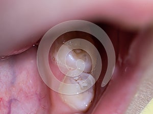 Caries on a baby's tooth, close-up. Concept of dental treatment for children in modern dentistry, macro. Diseases of