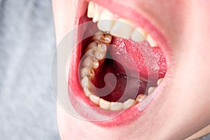 Caries. Dental cavities due to improper oral care.