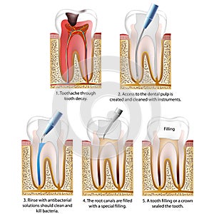 Caries destroyed tooth repaired with a crown or a tooth filling vector illustration process photo