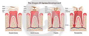 Caries development. Dental disease stages: enamel and dentin caries photo