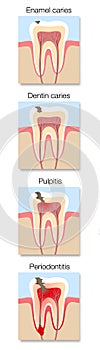Caries Development Stages Cross Sections Tooth Decay