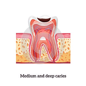 Caries Realistic Illustration