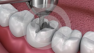 Caries removal, Dental fissure fillings,
