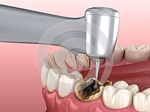 Caries removing process. Medically accurate tooth 3D illustration