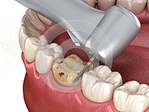 Caries removing process. Medically accurate tooth 3D illustration