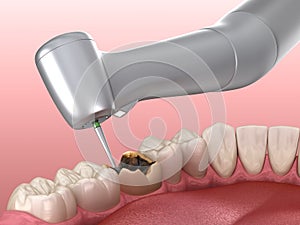 Caries removing process. Medically accurate tooth illustration
