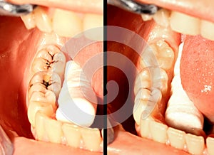 Caries and restoration photo