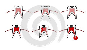 Caries stage, tooth decay scheme with caries, stomatological illustration with dental diseases, point by point schematic photo