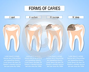 Caries stages of development. Visual aid for students, dentists, clinic patients. Defeat the source of destruction in the teeth. V