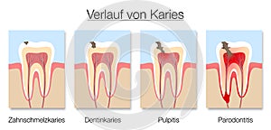 Caries Stages German Names Development Tooth Decay Cross Sections