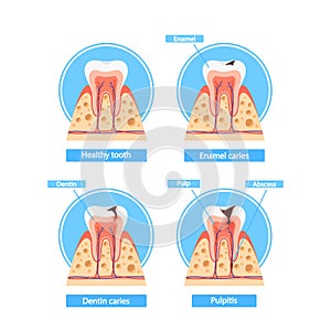 Caries Stages Infographics. Healthy Tooth, Enamel Caries, Dentin Caries, and Pulpitis Cross Section View, Medical Visual