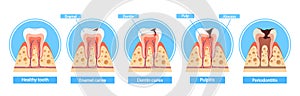 Caries Stages Infographics. Healthy Tooth, Enamel Caries, Dentin Caries, Pulpitis And Periodontitis Cross Section View photo