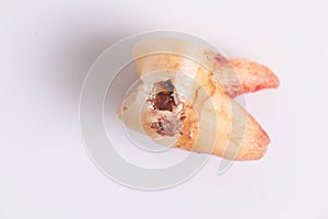 Caries on the teeth on the white background