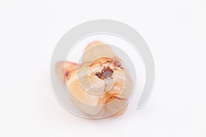 Caries on the teeth on the white background